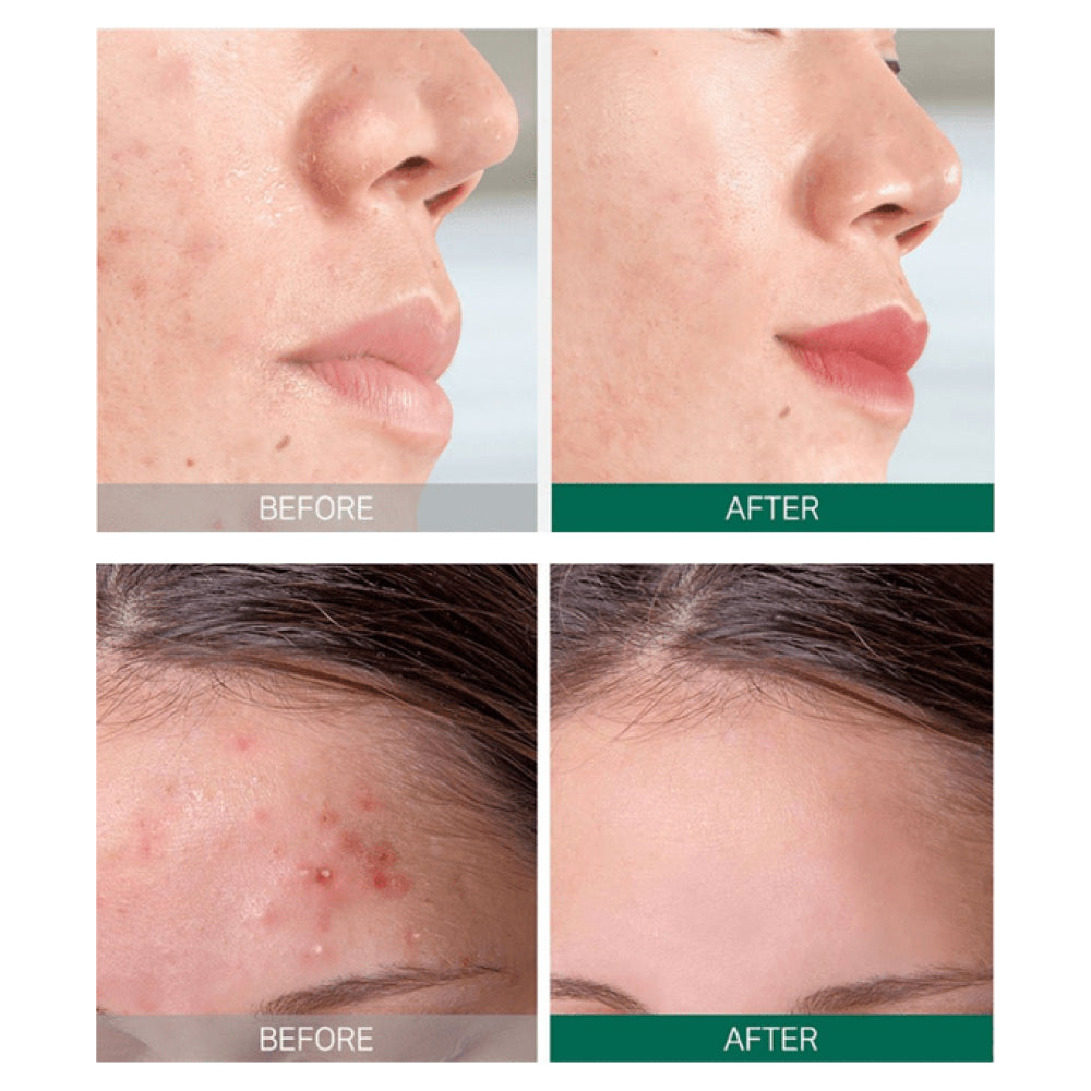 Some By Mi AHA.BHA.PHA 30 Days Miracle Starter طقم Edition 4 قطعة - الصورة 2